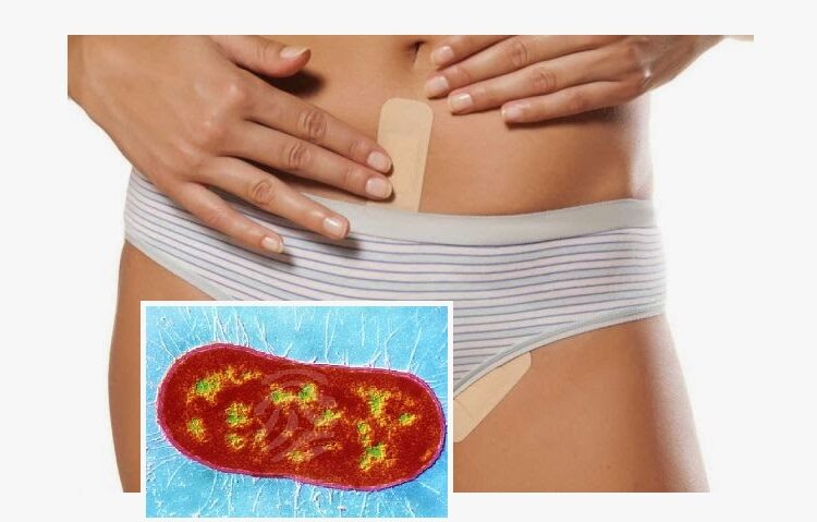 Advierten del aumento de la incidencia en el Reino Unido de la infección de una bacteria ‘comecarne’ de transmisión sexual