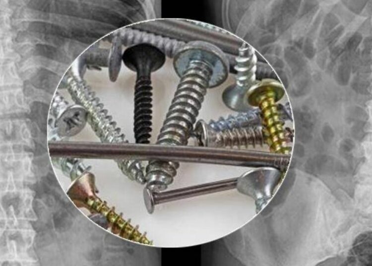 Extraen más de un kilo de clavos y tornillos del estómago de un hombre en Lituania