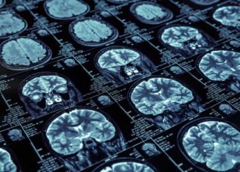 Descubren el mecanismo de avance del Alzheimer en el cerebro