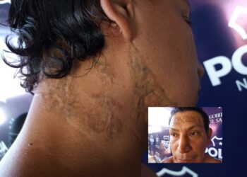 Capturan a pandillero que trató de ocultar sus tatuajes con quemaduras
