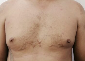 Capturan a otro pandillero que intentó borrarse los tatuajes con quemaduras