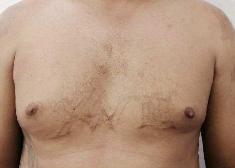 Capturan a otro pandillero que intentó borrarse los tatuajes con quemaduras