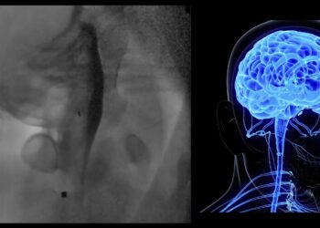 Crearon mini robots para tratar enfermedades cerebrales como Parkinson