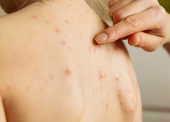 La OMS convocó a una reunión de emergencia mientras los casos de viruela del mono se extienden por el mundo