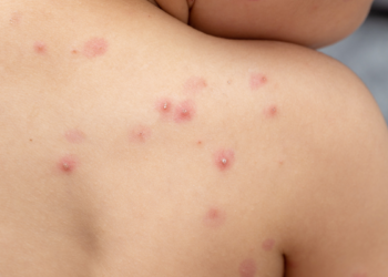 La OMS declara la viruela del mono como una emergencia de salud pública de interés internacional