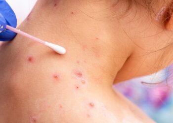 Bruselas aprueba vacuna contra viruela del mono