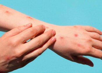 Confirman la primera muerte por viruela del mono en Brasil