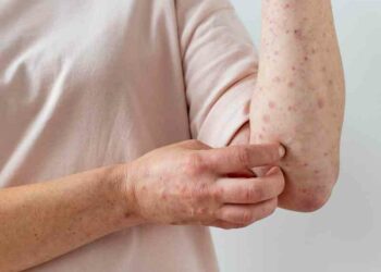 Viruela símica no solo se contagia mediante transmisión sexual, afirma ministro de Salud