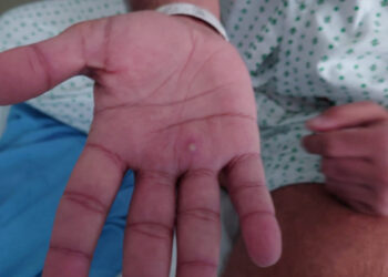 Descubren nuevos síntomas de la viruela del mono