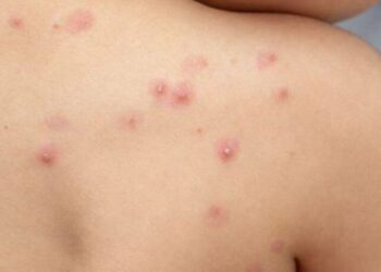 Detectan el cuarto caso de “Viruela del Mono” en Guatemala