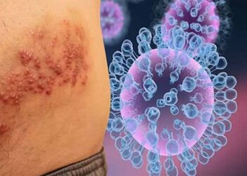 El Ministerio de Salud de Guatemala detecta primer caso de viruela del mono e investiga otros tres