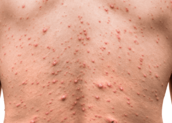 Viruela del mono: cuál es la principal vía de transmisión, según los expertos