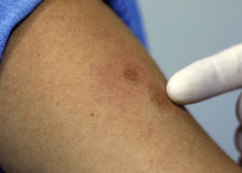 Se confirma el primer caso de viruela del mono en Honduras