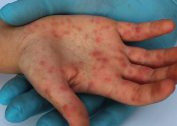 Ministerio de Salud confirma dos casos más de viruela símica en el país