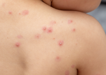 Ministerio de Salud confirma quinto caso de viruela símica en El Salvador