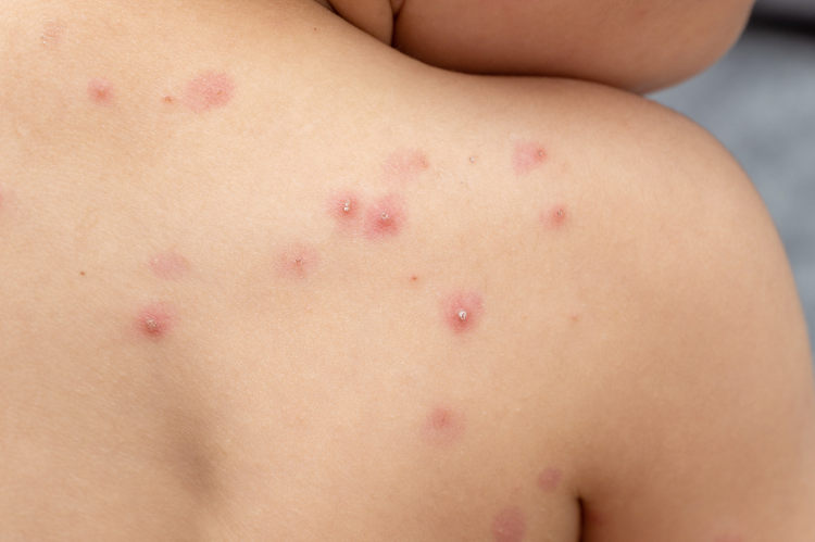 Ministerio de Salud confirma quinto caso de viruela símica en El Salvador