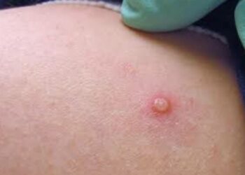 MINSAL confirma dos nuevos casos de viruela del mono