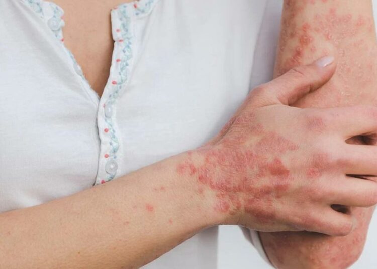 Viruela del mono supera 50.000 casos a nivel mundial