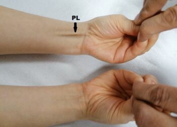 La población mundial está perdiendo este músculo del antebrazo