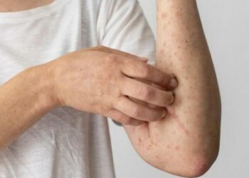 Ascienden a 11 los casos de viruela símica en el país