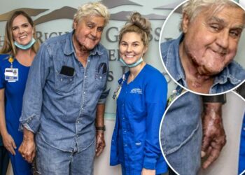 Jay Leno fue dado de alta tras la explosión que le provocó quemaduras