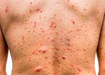 Casos registrados de viruela símica suman 15 en el territorio nacional