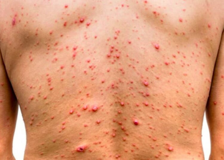 Casos registrados de viruela símica suman 15 en el territorio nacional