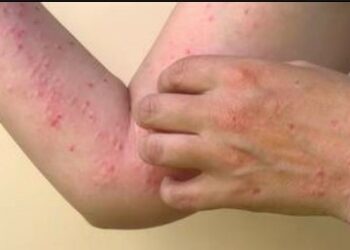 Ascienden a 19 los contagios registrados de viruela símica en el país, 17 recuperados y 2 nuevos detectados