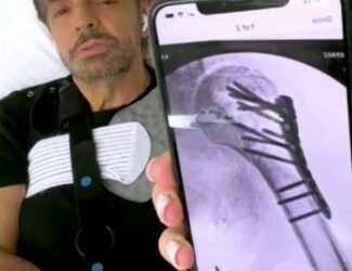 Médicos aseguran que Eugenio Derbez no volverá a levantar su brazo