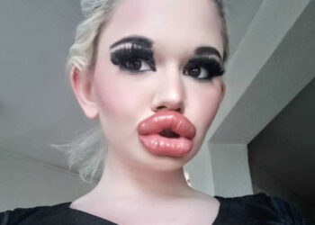 La mujer «con los labios más grandes del mundo» va por un nuevo récord