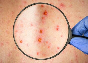 La viruela del mono tiene nuevo nombre: la OMS la denominó “mpox”