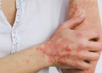 El Salvador contabiliza cerca de 30 personas recuperadas por viruela símica