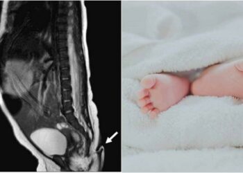 Se registró el nacimiento de una bebé con cola de casi 6 centímetros de largo en el norte de México