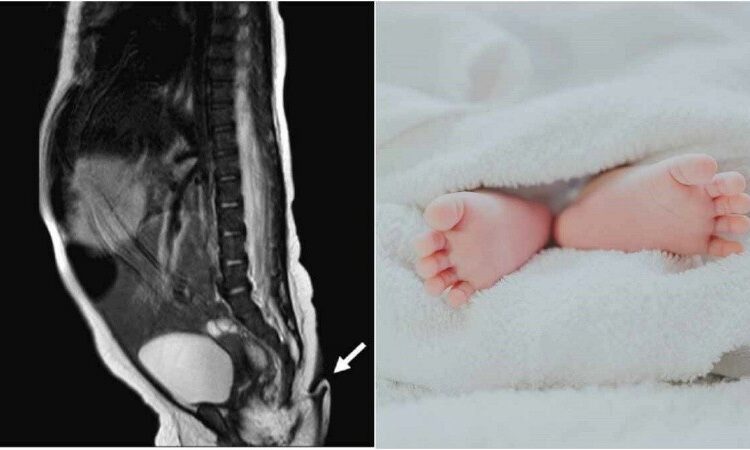 Se registró el nacimiento de una bebé con cola de casi 6 centímetros de largo en el norte de México
