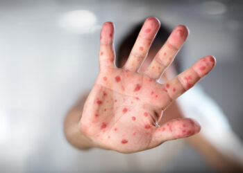 El Salvador no registra casos activos de viruela símica