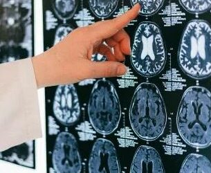 China reporta el primer caso de alzhéimer en un joven de 19 años