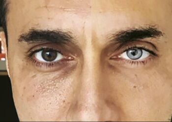 En qué consiste la polémica operación para cambiar el color de los ojos