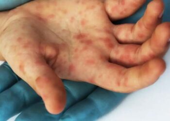 El Salvador registra cero letalidades por viruela símica