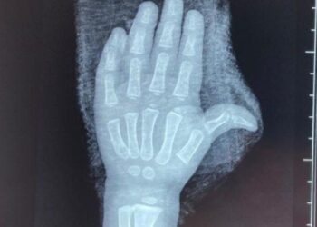 Niña que tuvo accidente en gradas eléctricas de un centro comercial ya fue operada y dada de alta en el Hospital Bloom