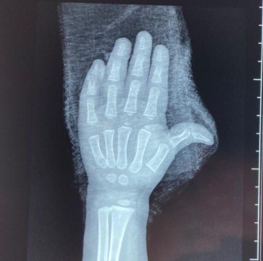 Niña que tuvo accidente en gradas eléctricas de un centro comercial ya fue operada y dada de alta en el Hospital Bloom