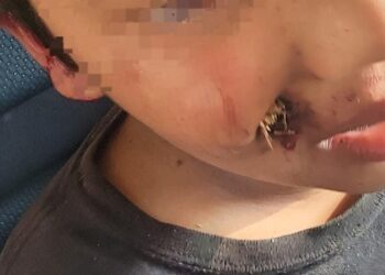 Socorristas de Comandos de Salvamento auxilian a un menor que se le incrustó una rama en el rostro