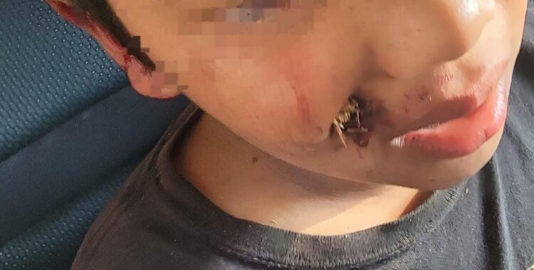 Socorristas de Comandos de Salvamento auxilian a un menor que se le incrustó una rama en el rostro