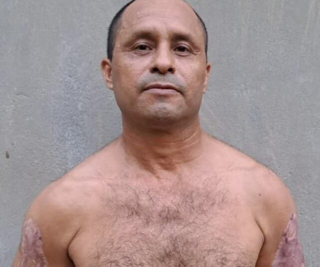 Gatillero de la 18R intentó eliminar sus tatuajes alusivos a las pandillas quemándolos