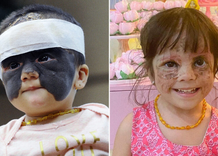 Niña estadounidense que nació con ‘máscara de Batman’ responde con éxito a tratamiento médico ruso