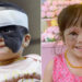 Niña estadounidense que nació con ‘máscara de Batman’ responde con éxito a tratamiento médico ruso