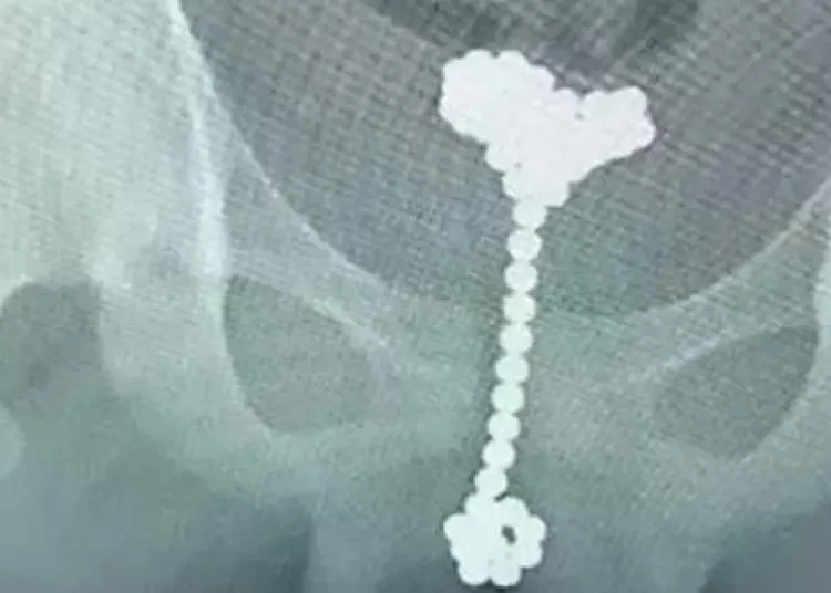 Un adolescente introduce en su pene 50 bolas magnéticas en Rusia