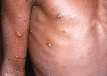 La OMS convocó un panel para determinar la gravedad y el alcance de un brote de viruela símica en África Central