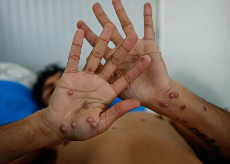 La OMS declara emergencia sanitaria internacional por la viruela del mono