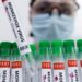 España reporta reducción en casos positivos de Mpox
