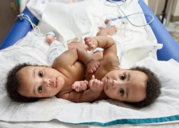 Siameses fueron separados con éxito tras casi un año en el hospital